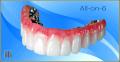 ALL-ON-6 TOOTH REPLACEMENT – ORAL REHABILITATION IN 3 WEEKS