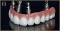 DENTAL IMPLANT-BASED ORAL REHABILITATION WITH SEDATION