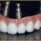 DENTAL-IMPLANT-BASED-ORAL