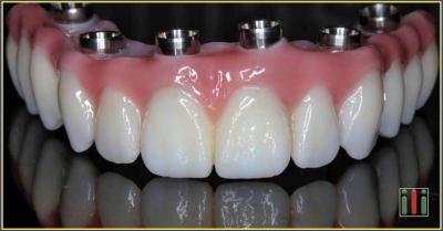 Implantátum-beültetés-ár