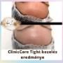 ClinicCare Tight kezelés eredménye