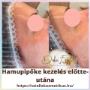 Hamupipőke kezelés