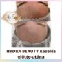 Hydra Beauty előtte-utána