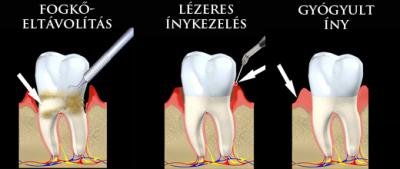 lézeres-ínykezelés