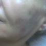 Biolifting 4.kezelés után
