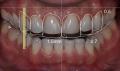 smile-design